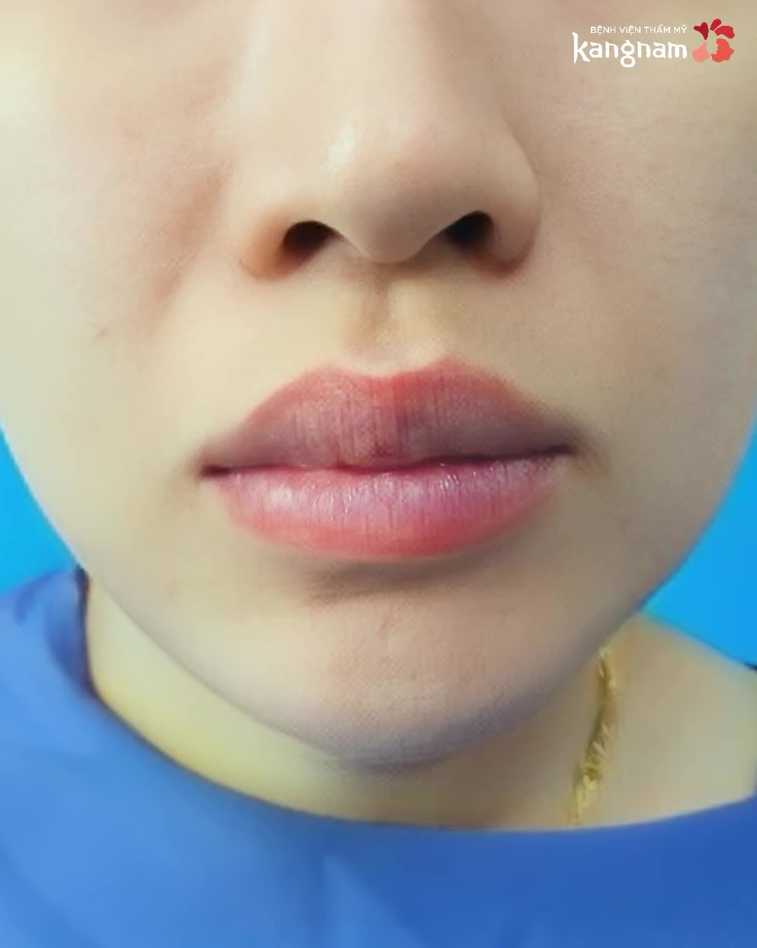 Môi trên dày + Mắt một mí kém duyên